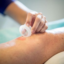 oedeem-therapie-cupping oedeem-therapie-cupping